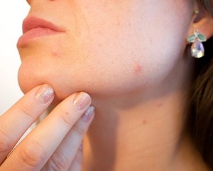 Tarsul dietary supplement can treat acne