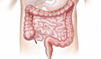 Treat IBS with Tarsul