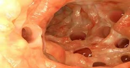 leaky gut syndrome intestinal permeability tarsul