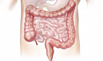 Treat IBS with Tarsul