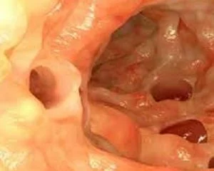 Tarsul Treats Leaky Gut Syndrome