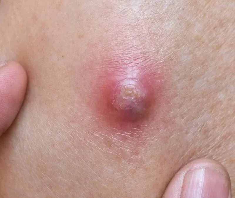 Boils Support with Tarsul: Natural Remedy with Organic Sulfur & Potassium