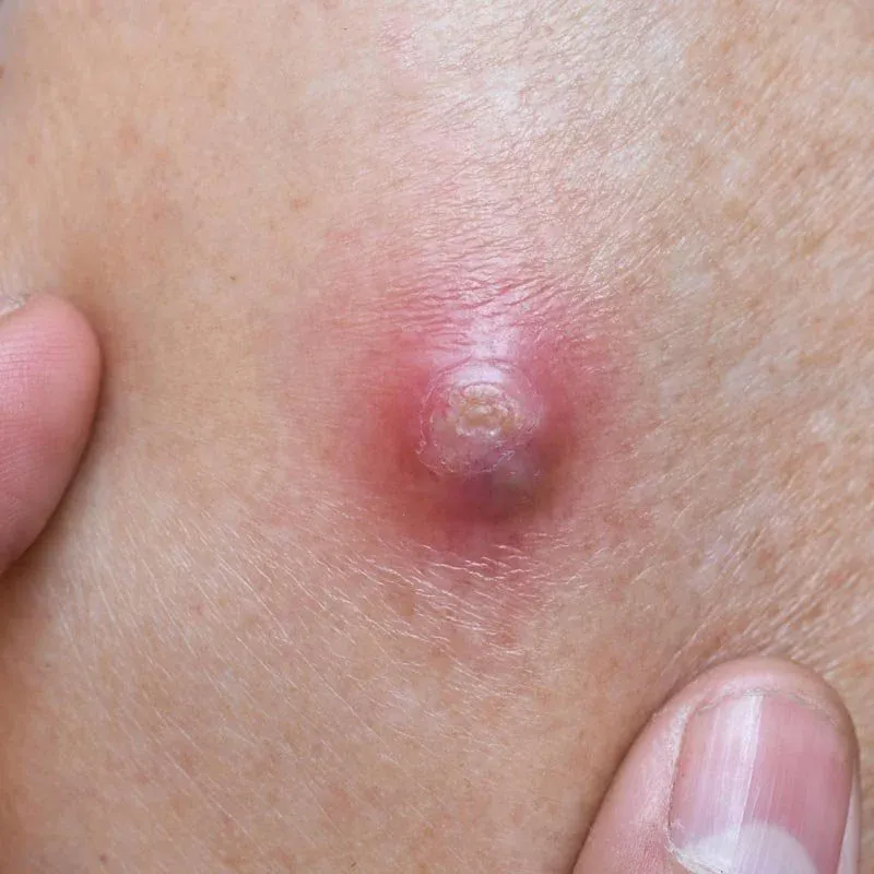 Boils support and natural skin infection relief