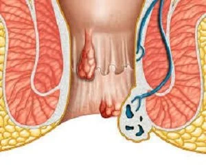 Hemorrhoids support and vein health