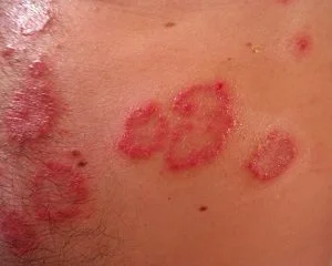 Psoriasis support and skin health relief